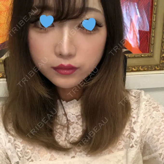 ヒアルロン酸注入（鼻） プライベートスキンクリニック 梅田本院 BEFORE メイン用