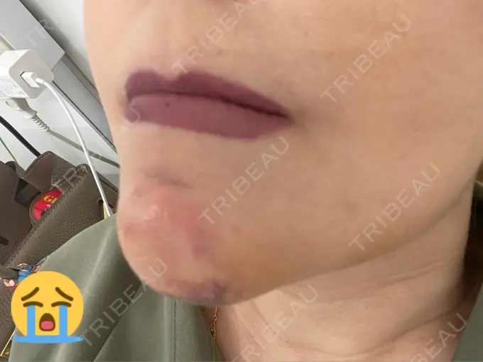 あごプロテーゼ / 輪郭修正 / ボトックス（あご） / ヒアルロン酸注入（頬） CLASSY 仙台美容外科・美容皮膚科 BEFORE メイン用