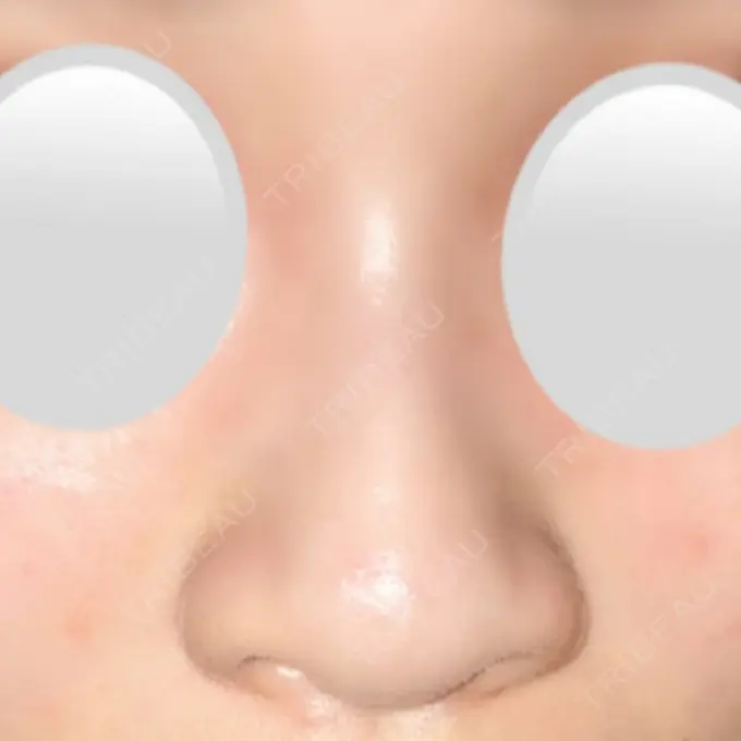 鼻中隔延長（切開） / 小鼻縮小（切開） / 鼻尖縮小 みずほクリニック BEFORE メイン用