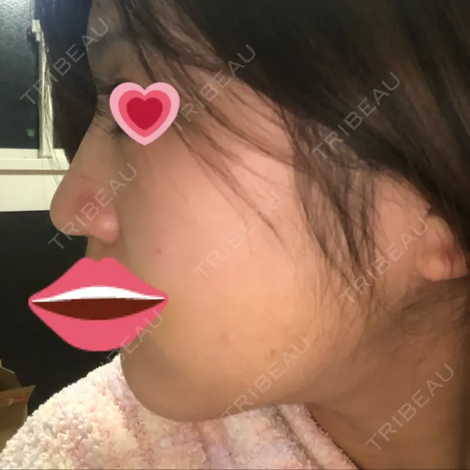 ヒアルロン酸注入（鼻） プライベートスキンクリニック 梅田本院 BEFORE メイン用