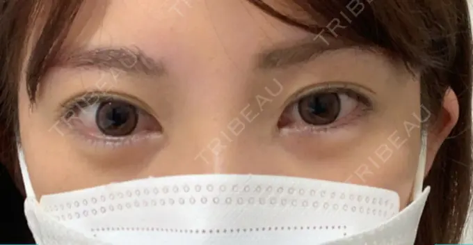 ヒアルロン酸注入（涙袋） / ボトックス（目尻） フィラークリニック 町田院 BEFORE メイン用