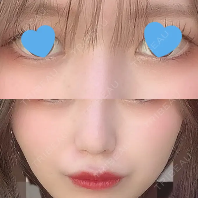 ヒアルロン酸注入（涙袋） / ヒアルロン酸注入（鼻） / ヒアルロン酸注入（唇） / ボトックス（口角） ルラ美容クリニック 大宮院 / ルラスキンクリニック 大宮院 BEFORE メイン用