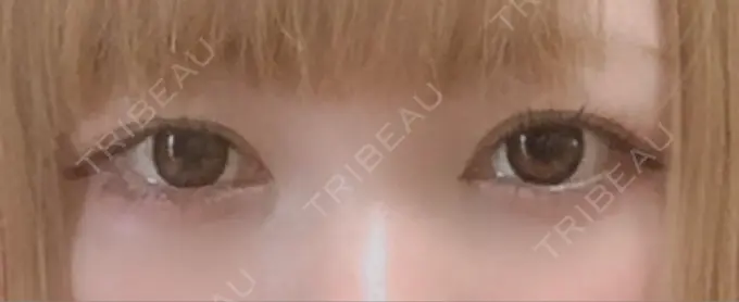 二重埋没 くさのたろうクリニック BEFORE メイン用