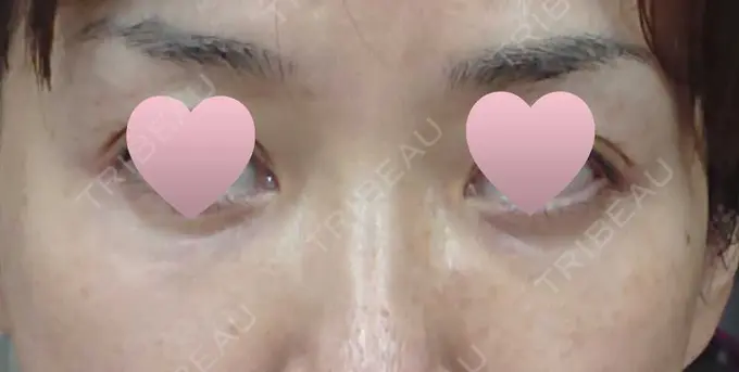 その他（目元） 赤坂プレミアクリニック BEFORE メイン用