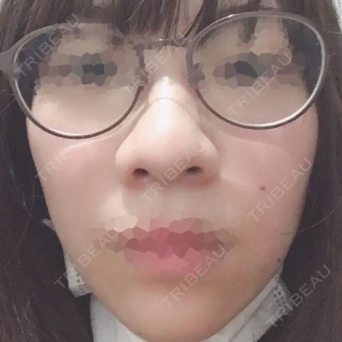隆鼻術 / 鼻尖形成（切開） / 小鼻縮小（切開） 湘南美容クリニック 岡山院 BEFORE メイン用