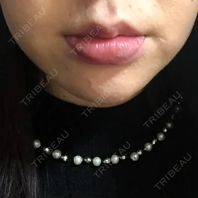 口唇縮小術 品川美容外科池袋院 BEFORE メイン用