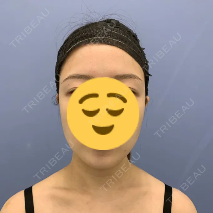 糸リフト / 脂肪吸引（顔） / メーラーファット除去 / ボトックス（エラ・小顔） 湘南美容クリニック 秋葉原院 BEFORE メイン用