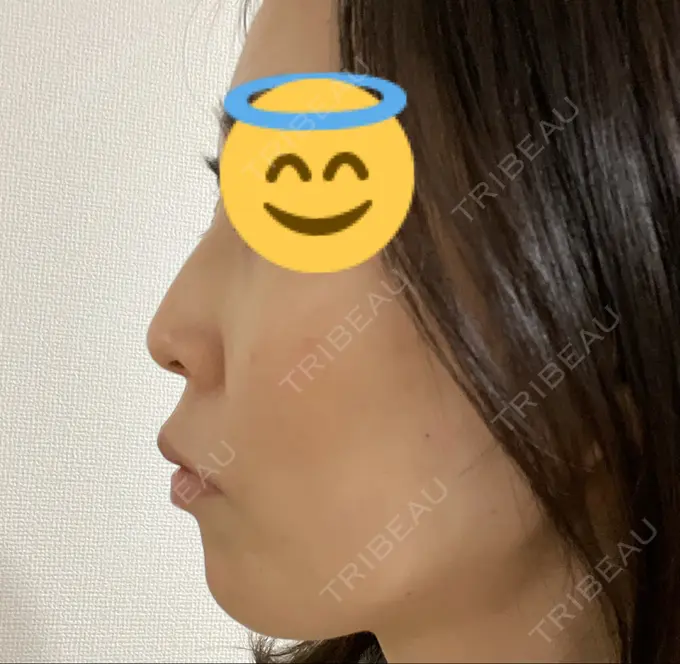 鼻尖形成（切開） / 鼻中隔延長（切開） みずほクリニック BEFORE メイン用