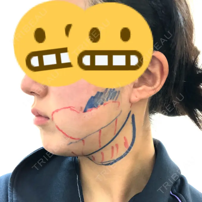 脂肪吸引（顔） THE CLINIC（ザ・クリニック） 東京院 BEFORE メイン用