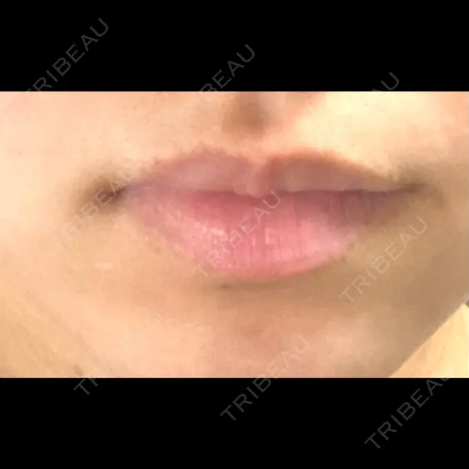 ヒアルロン酸注入（唇） / ボトックス（口角） フィラークリニック 名古屋栄院 BEFORE メイン用