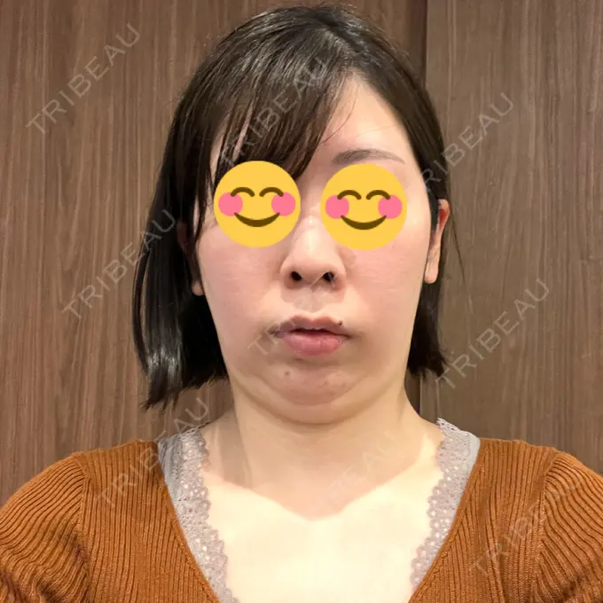 脂肪吸引（顔） みずほクリニック BEFORE メイン用