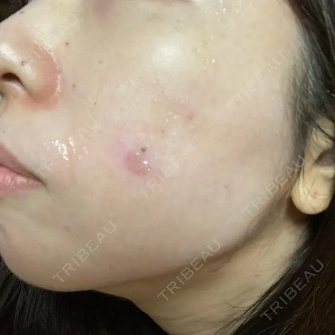 シミ取りレーザー / 光治療（フォトフェイシャルなど） 東京ミッドクリニック BEFORE メイン用