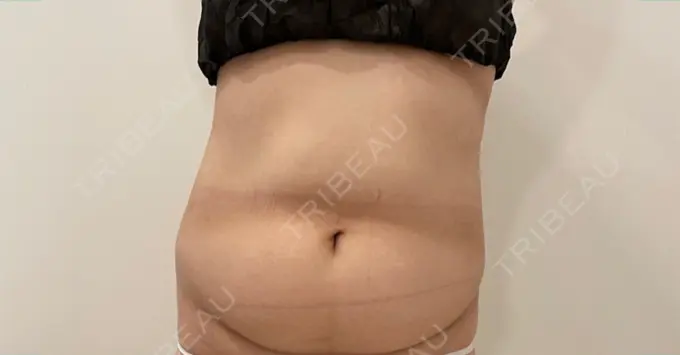 脂肪吸引（お腹） / インディバ（お腹） 藤・ナチュレ美容クリニック 恵比寿院 BEFORE メイン用