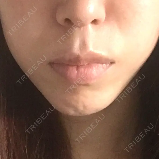 あごプロテーゼ / 骨切り（あご） ジョウクリニック 大阪院 BEFORE メイン用