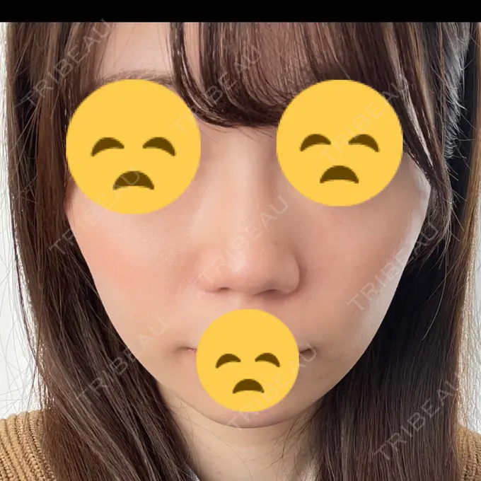 軟骨移植 / 鼻尖縮小 みずほクリニック BEFORE メイン用