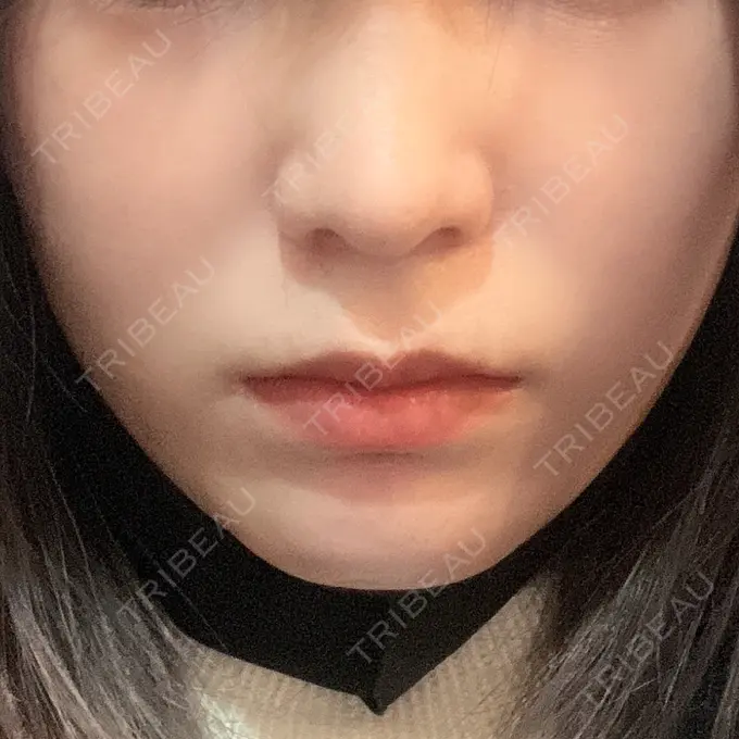 ヒアルロン酸注入（あご） 東京形成美容外科 船橋院 BEFORE メイン用