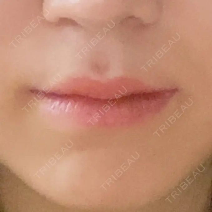 ヒアルロン酸注入（唇） / ボトックス（口角） ルラ美容クリニック 大宮院 / ルラスキンクリニック 大宮院 BEFORE メイン用