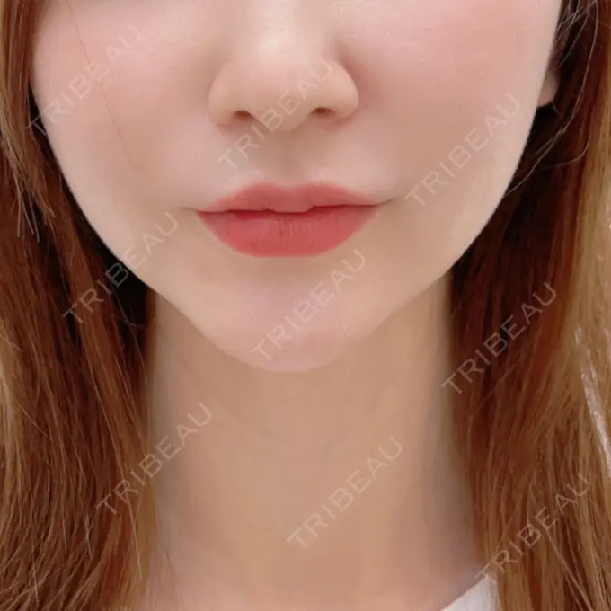 ピーリング（ニキビ・毛穴） / イオン導入 渋谷美容外科クリニック 横浜院 BEFORE メイン用