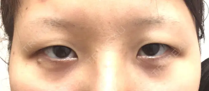 眼瞼下垂（切開） みずほクリニック BEFORE メイン用