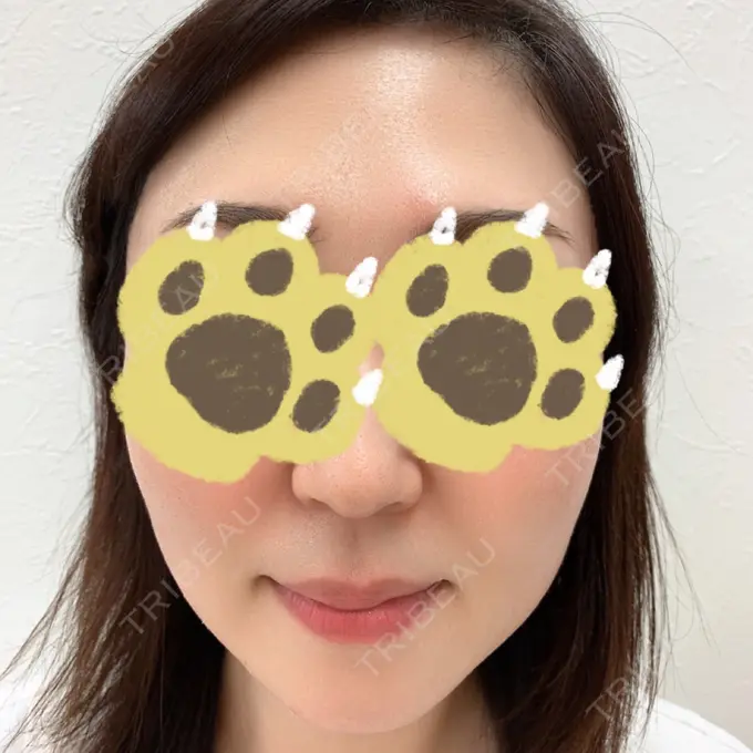 ピーリング（ハリ・ツヤ） 渋谷美容外科クリニック 横浜院 BEFORE メイン用