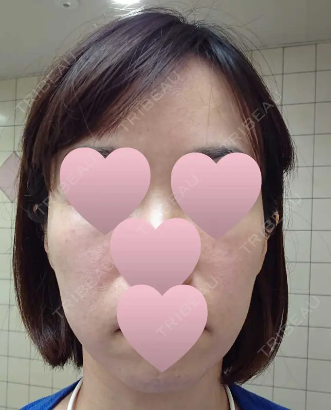 ハイフ（顔） 赤坂プレミアクリニック BEFORE メイン用