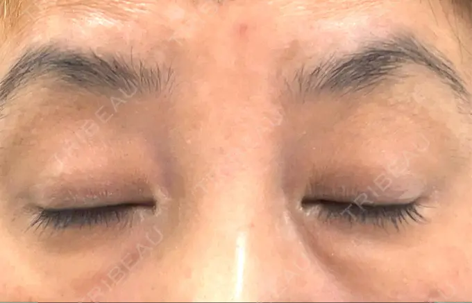 ヒアルロン酸注入（目の下） 渋谷美容外科クリニック 渋谷院 BEFORE メイン用