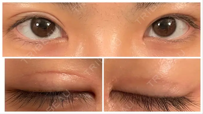 二重切開 こまちクリニック BEFORE メイン用