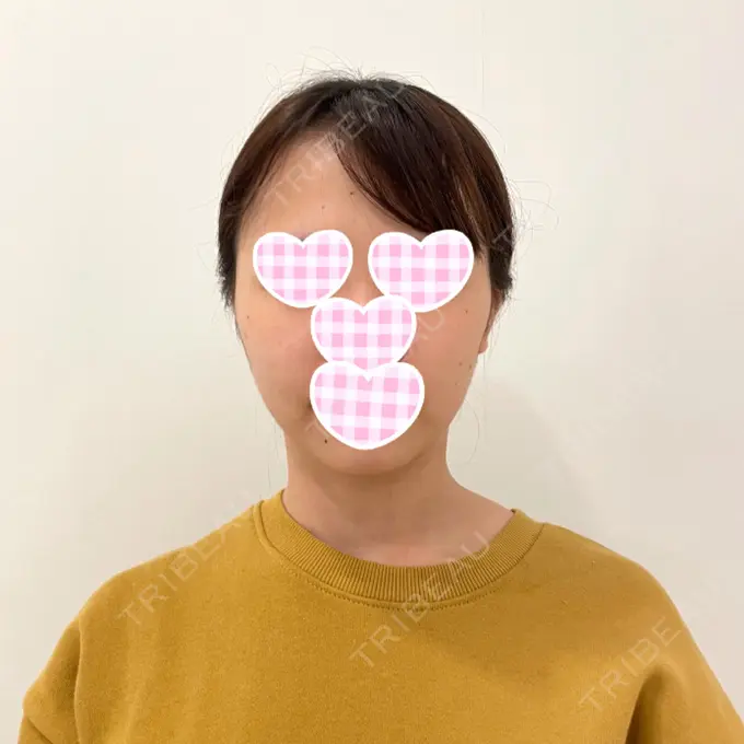 糸リフト / 脂肪吸引（顔） / メーラーファット除去 / ヒアルロン酸注入（あご） 藤・ナチュレ美容クリニック 恵比寿院 BEFORE メイン用