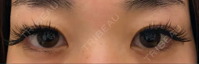 二重切開 / 上まぶたの脂肪取り 心斎橋コムロ美容外科クリニック BEFORE メイン用