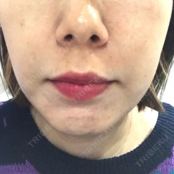 ボトックス（エラ・小顔） TCB東京中央美容外科 心斎橋筋院 BEFORE メイン用