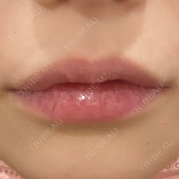 ヒアルロン酸注入（唇） YBC横浜美容外科 大宮院 BEFORE メイン用