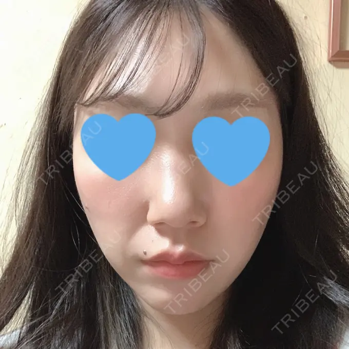 糸リフト / 脂肪吸引（顔） 湘南美容クリニック 長野院 BEFORE メイン用