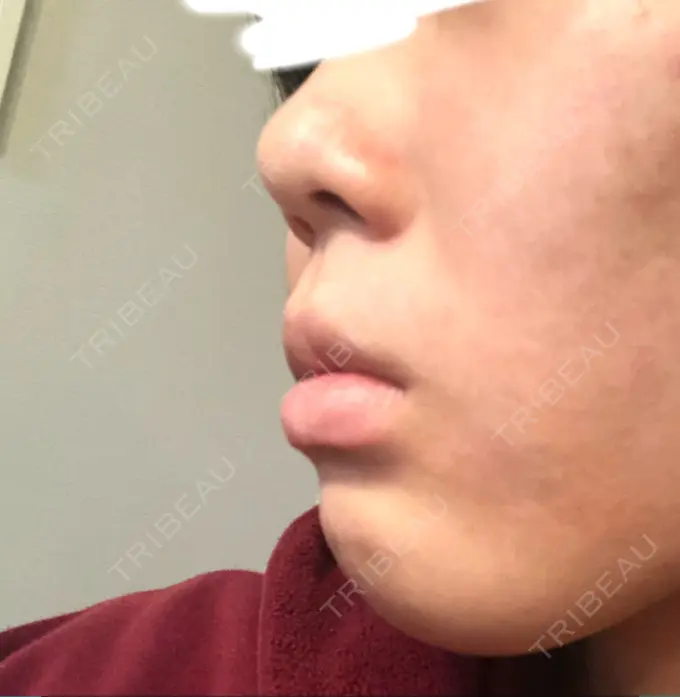 ボトックス（あご） TCB東京中央美容外科 新宿東口院 BEFORE メイン用