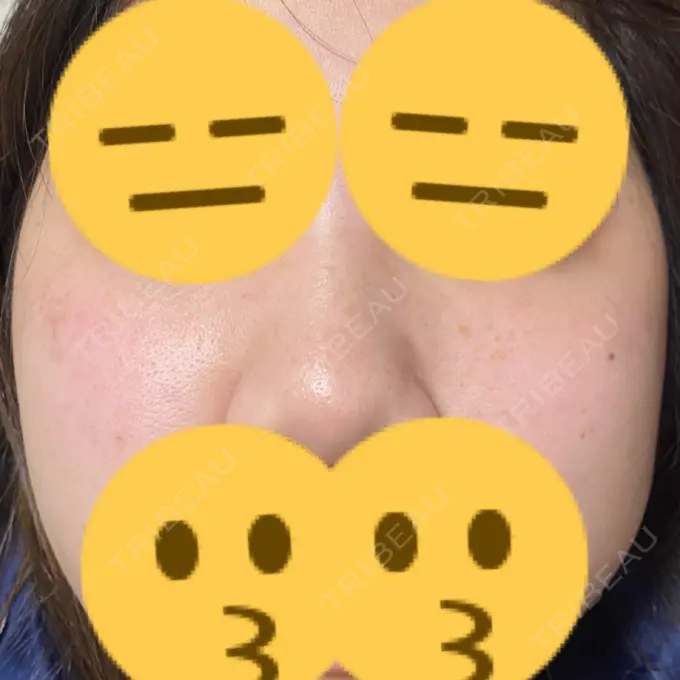 ルビーレーザー みずほクリニック BEFORE メイン用