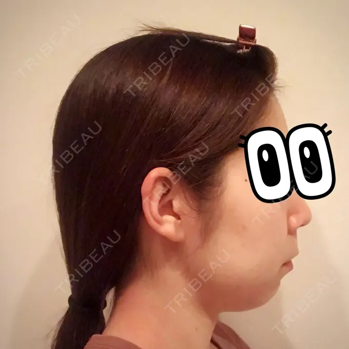 バッカルファット除去 / 脂肪吸引（顔） / ボトックス（エラ・小顔） THE PLAN（ザ・プラン）美容整形外科・皮膚科 BEFORE メイン用