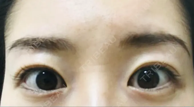 二重切開 有楽町高野美容クリニック BEFORE メイン用