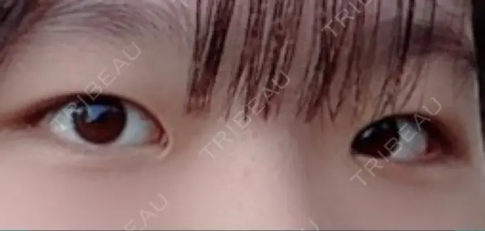 二重埋没 水の森美容クリニック 東京新宿院 BEFORE メイン用