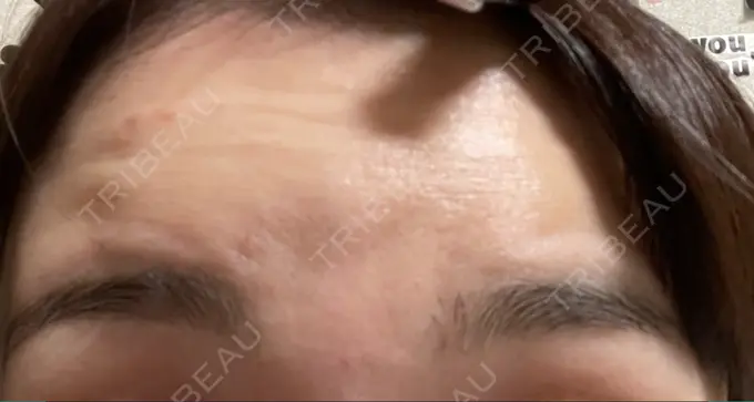 ボトックス（額） TCB東京中央美容外科 静岡院 BEFORE メイン用