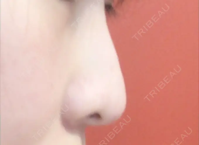 プロテーゼ除去 / 鼻修正 / 鼻孔縁下降 みずほクリニック BEFORE メイン用