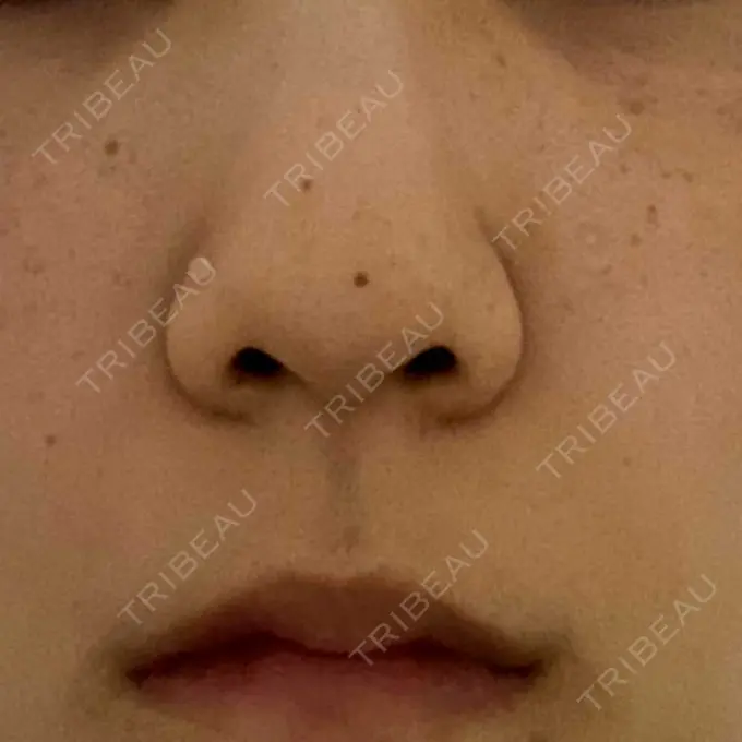 鼻尖形成（切開） / 鼻中隔延長（切開） / 軟骨移植 湘南美容クリニック 藤沢院 BEFORE メイン用