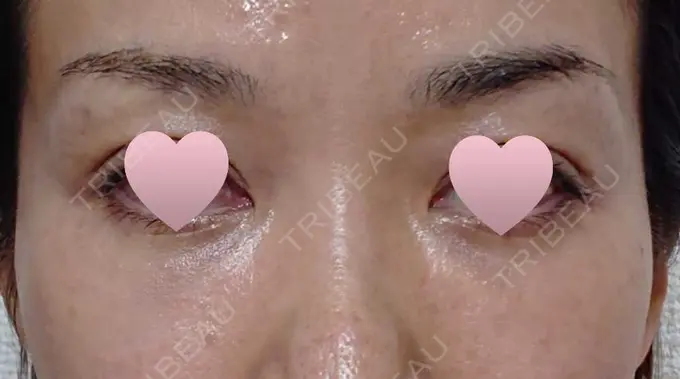 その他（目元） 赤坂プレミアクリニック BEFORE メイン用