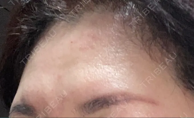 シワ取りボトックス TCB東京中央美容外科 宇都宮院 BEFORE メイン用