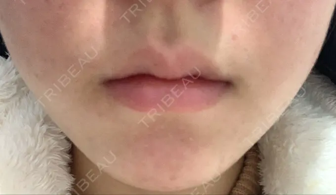 ヒアルロン酸注入（唇） YBC横浜美容外科 大宮院 BEFORE メイン用