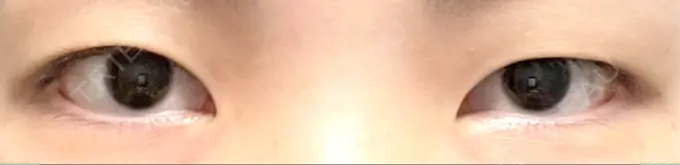 二重埋没 銀座S美容・形成外科クリニック BEFORE メイン用