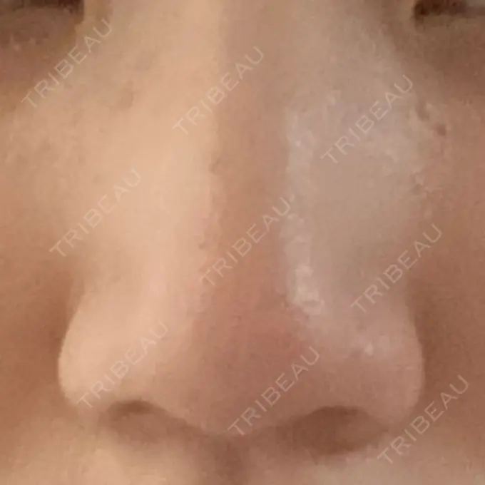 鼻尖形成（切開） / 小鼻縮小（切開） / 軟骨移植 麹町皮ふ科・形成外科クリニック BEFORE メイン用