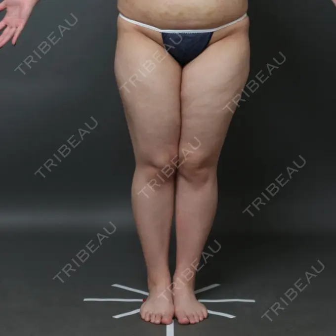 脂肪吸引（脚） THE CLINIC（ザ・クリニック） 名古屋院 BEFORE メイン用