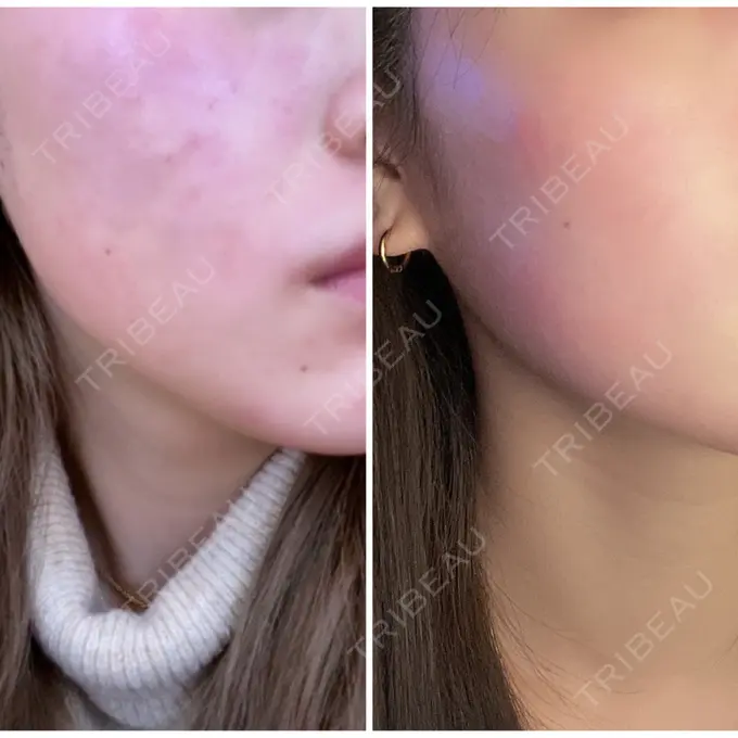 エレクトロポレーション / 毛穴洗浄（ハイドラフェイシャルなど） AURORA CLINIC（オーロラクリニック）新宿院 BEFORE メイン用