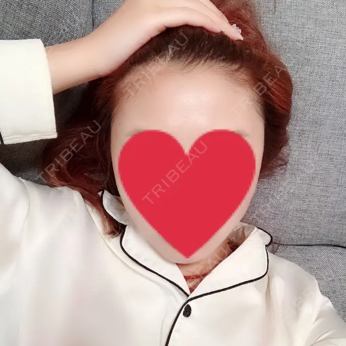 バッカルファット除去 / 脂肪吸引（顔） / 額を丸く / ヒアルロン酸注入（あご） / ボトックス（エラ・小顔） / ヒアルロン酸注入（額） エートップ美容整形外科 BEFORE メイン用