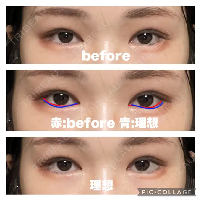 タレ目形成・グラマラスライン（切開） / 目元修正 銀座マイアミ美容外科 BEFORE メイン用