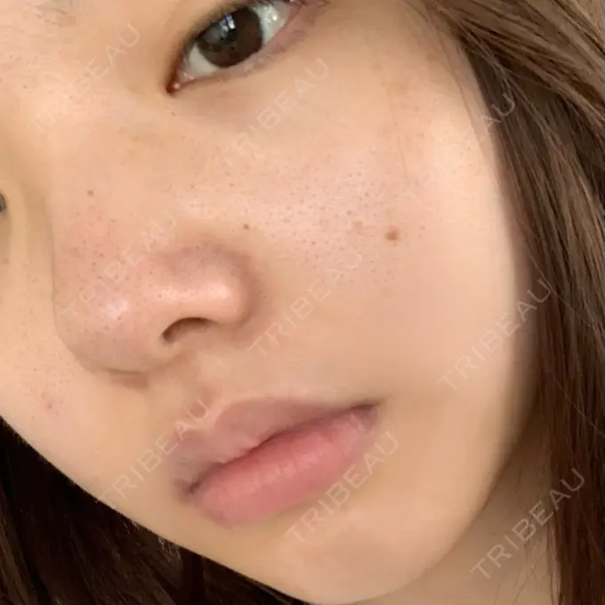 エレクトロポレーション / 毛穴洗浄（ハイドラフェイシャルなど） AURORA CLINIC（オーロラクリニック）新宿院 BEFORE メイン用